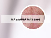 妇炎洁治银屑病 妇炎洁治癣吗