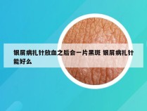 银屑病扎针放血之后会一片黑斑 银屑病扎针能好么