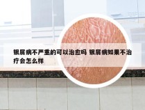 银屑病不严重的可以治愈吗 银屑病如果不治疗会怎么样