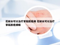 花椒水可以治疗掌跖脓疱病 花椒水可以治疗掌跖脓疱病嘛