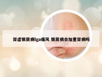 肾虚银屑病lga痛风 银屑病会加重肾病吗