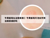 牛黄解毒丸治银屑病嚒 牛黄解毒片泡水外擦治银屑病好吗