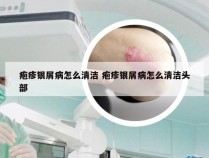 疱疹银屑病怎么清洁 疱疹银屑病怎么清洁头部