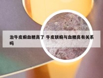 治牛皮癣血糖高了 牛皮肤癣与血糖高有关系吗