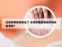 点滴状银屑病自愈了 点滴状银屑病治好后会复发吗?