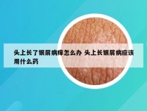 头上长了银屑病痒怎么办 头上长银屑病应该用什么药