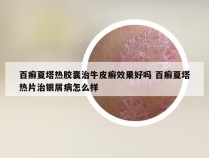 百癣夏塔热胶囊治牛皮癣效果好吗 百癣夏塔热片治银屑病怎么样