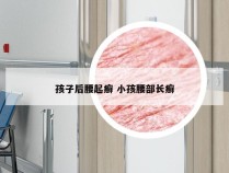 孩子后腰起癣 小孩腰部长癣