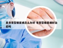 患寻常型银屑病怎么办好 寻常型银屑病好治愈吗