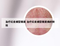 治疗红皮病型银屑 治疗红皮病型银屑病的特效