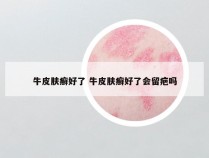 牛皮肤癣好了 牛皮肤癣好了会留疤吗