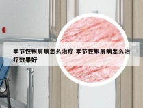 季节性银屑病怎么治疗 季节性银屑病怎么治疗效果好