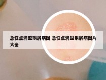 急性点滴型银屑病图 急性点滴型银屑病图片大全