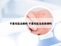 千里光能治癣吗 千里光能治皮肤病吗