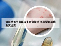 银屑病关节炎血沉多高会能动 关节型银屑病血沉过高