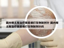 国内哪儿有治疗银屑病打生物制剂针 国内哪儿有治疗银屑病打生物制剂针的