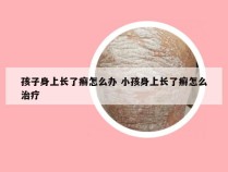 孩子身上长了癣怎么办 小孩身上长了癣怎么治疗