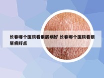 长春哪个医院看银屑病好 长春哪个医院看银屑病好点