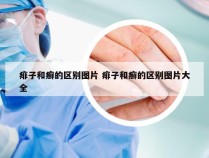 痱子和癣的区别图片 痱子和癣的区别图片大全