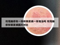 玫瑰糠疹和一样和银屑病一样难治吗 玫瑰糠疹和银屑病图片对比