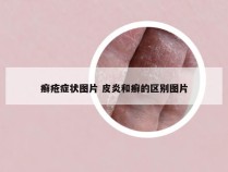 癣疮症状图片 皮炎和癣的区别图片