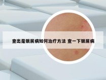 查出是银屑病如何治疗方法 查一下银屑病