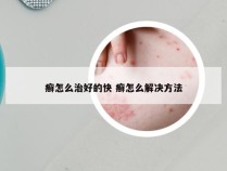 癣怎么治好的快 癣怎么解决方法