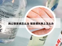 胸口银屑病怎么治 银屑病长胸上怎么办