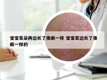 宝宝耳朵两边长了像癣一样 宝宝耳边长了像癣一样的