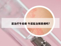 尿治疗牛皮癣 牛尿能治银屑病吗?