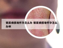 银屑病很难怀孕怎么办 银屑病很难怀孕怎么办啊