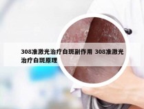 308准激光治疗白斑副作用 308准激光治疗白斑原理