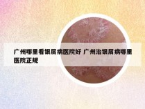 广州哪里看银屑病医院好 广州治银屑病哪里医院正规