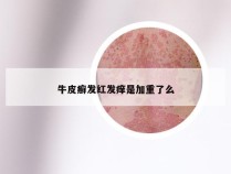 牛皮癣发红发痒是加重了么