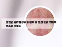 慢性苔藓样糠疹和副银屑病 慢性苔藓样糠疹是真菌感染吗