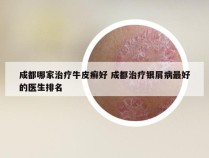 成都哪家治疗牛皮癣好 成都治疗银屑病最好的医生排名