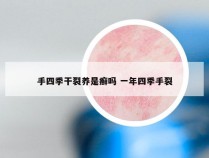 手四季干裂养是癣吗 一年四季手裂