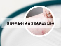 基因干预治疗牛皮癣 基因皮肤病怎么治疗