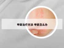 甲藓治疗方法 甲藓怎么办