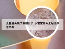 儿童眉头出了癣摸什么 小宝宝眉头上起湿疹怎么办