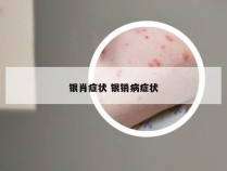 银肖症状 银销病症状