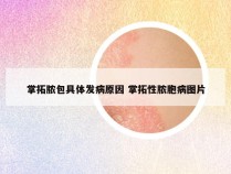 掌拓脓包具体发病原因 掌拓性脓胞病图片