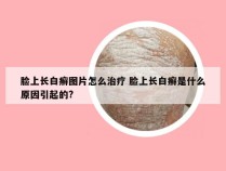 脸上长白癣图片怎么治疗 脸上长白癣是什么原因引起的?