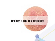 皂角刺怎么治癣 皂角刺治癣偏方