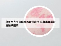 乌鲁木齐牛皮肤癣怎么样治疗 乌鲁木齐最好皮肤病医院