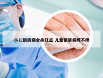 小儿银屑病全身红点 儿童银屑病痒不痒