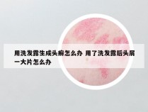 用洗发露生成头癣怎么办 用了洗发露后头屑一大片怎么办