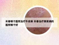 长春哪个医院治疗牛皮癣 长春治疗银屑病的医院哪个好