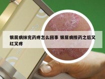 银屑病抹完药疼怎么回事 银屑病擦药之后又红又疼