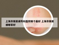 上海市银屑病专科医院哪个最好 上海市银屑病哪家好